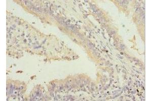 Immunohistochemistry of paraffin-embedded human lung cancer using ABIN7153505 at dilution of 1:100 (GABRR1 antibody  (AA 365-465))