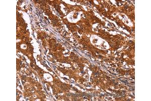 Immunohistochemistry of Human gastric cancer using ABI1 Polyclonal Antibody at dilution of 1:40