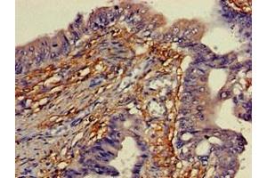 Immunohistochemistry of paraffin-embedded human colon cancer using ABIN7166338 at dilution of 1:100