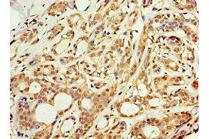 Immunohistochemistry of paraffin-embedded human breast cancer using ABIN7143228 at dilution of 1:100 (ACSM3 antibody  (AA 387-586))