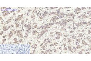 Immunohistochemistry of paraffin-embedded Human liver cancer tissue using EIF2 alpha Polyclonal Antibody at dilution of 1:200. (EIF2A antibody)