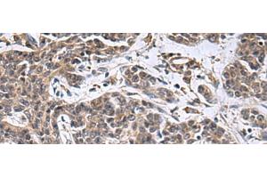 Immunohistochemistry of paraffin-embedded Human colorectal cancer tissue using MBL2 Polyclonal Antibody at dilution of 1:25(x200) (MBL2 antibody)