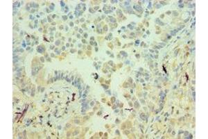 Immunohistochemistry of paraffin-embedded human lung cancer using ABIN7156537 at dilution of 1:100 (ICAM2 antibody  (AA 25-223))