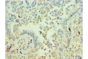Immunohistochemistry of paraffin-embedded human lung cancer using ABIN7156537 at dilution of 1:100