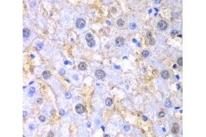 Immunohistochemistry of paraffin-embedded Human liver damage using FAH Polyclonal Antibody at dilution of 1:100 (40x lens).