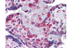 Immunohistochemistry (IHC) image for anti-Y Box Binding Protein 1 (YBX1) (Middle Region) antibody (ABIN2775773) (YBX1 antibody  (Middle Region))