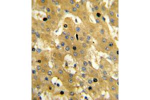 Formalin-fixed and paraffin-embedded human hepatocarcinoma reacted with SCP2 Antibody , which was peroxidase-conjugated to the secondary antibody, followed by DAB staining. (SCP2 antibody  (AA 358-385))