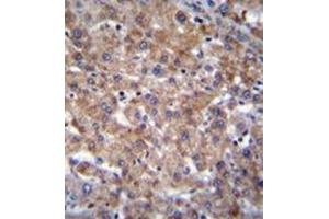 Immunohistochemistry analysis in formalin fixed and paraffin embedded human liver tissue reacted with PLEKHA4 Antibody (N-term) followed which was peroxidase conjugated to the secondary antibody and followed by DAB staining. (PLEKHA4 antibody  (N-Term))