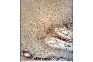 ITA6 Monoclonal Antibody (ABIN658988 and ABIN2838034) immunohistochemistry analysis in formalin fixed and paraffin embedded human skin carcinoma followed by peroxidase conjμgation of the secondary antibody and DAB staining. (ITGA6 antibody)