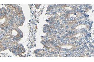 ABIN6276484 at 1/100 staining Human prostate tissue by IHC-P. (ARPC1A antibody  (C-Term))