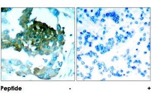 Immunohistochemical analysis of paraffin-embedded human lung carcinoma tissue using PRKCQ polyclonal antibody . (PKC theta antibody)