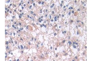 Detection of IL33 in Human Glioma Tissue using Monoclonal Antibody to Interleukin 33 (IL33) (IL-33 antibody  (AA 112-270))