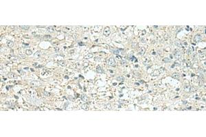 Immunohistochemistry of paraffin-embedded Human esophagus cancer tissue using DENND6A Polyclonal Antibody at dilution of 1:120(x200) (FAM116A antibody)