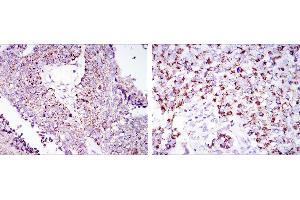 Immunohistochemical analysis of paraffin-embedded lung cancer tissues (left) and kidney cancer tissues (right) using HSP60 mouse mAb with DAB staining. (HSPD1 antibody)