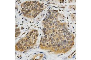 Immunohistochemistry of paraffin-embedded human esophageal cancer using ABO antibody at dilution of 1:200 (x400 lens).