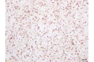 Formalin-fixed and paraffin embedded human breast carcinoma labeled with Rabbit Anti-YAP1 Polyclonal Antibody, Unconjugated 1:200 followed by conjugation to the secondary antibody and DAB staining (YAP1 antibody  (AA 131-330))