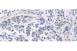 Immunohistochemistry of paraffin-embedded Human breast cancer tissue using LAMP3 Polyclonal Antibody at dilution of 1:30(x200) (LAMP3 antibody)