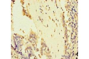 Immunohistochemistry of paraffin-embedded human lung cancer using ABIN7169011 at dilution of 1:100