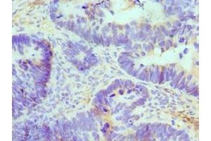 Immunohistochemistry of paraffin-embedded human ovarian cancer using ABIN7145049 at dilution of 1:100 (ATRIP antibody  (AA 1-260))