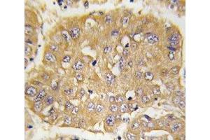 IHC analysis of FFPE human hepatocarcinoma tissue stained with IGFBP3 antibody (IGFBP3 antibody  (AA 163-193))