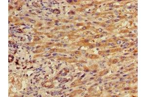 Immunohistochemistry of paraffin-embedded human liver cancer using ABIN7156490 at dilution of 1:100