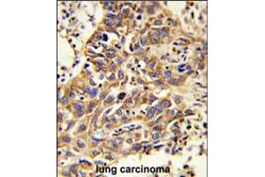 Formalin-fixed and paraffin-embedded human lung carcinoma reacted with CAT Antibody , which was peroxidase-conjugated to the secondary antibody, followed by DAB staining. (Catalase antibody  (AA 152-180))