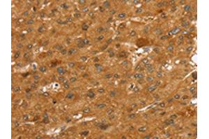 The image on the left is immunohistochemistry of paraffin-embedded Human liver cancer tissue using ABIN7192525(SLC7A9 Antibody) at dilution 1/35, on the right is treated with synthetic peptide. (SLC7A9 antibody)