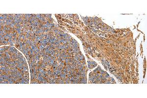 Immunohistochemistry of paraffin-embedded Human liver cancer tissue using CD151 Polyclonal Antibody at dilution 1:25 (CD151 antibody)
