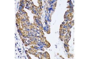 Immunohistochemistry (Paraffin-embedded Sections) (IHC (p)) image for anti-Tumor Protein P53 (TP53) (AA 1-100) antibody (ABIN6149405)