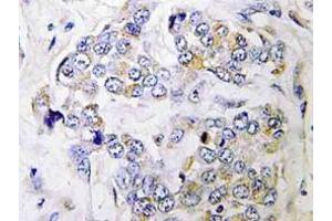 Immunohistochemistry (IHC) analyzes of PRIM1 antibody in paraffin-embedded human breast carcinoma tissue.