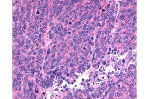 Anti-SSTR1 antibody IHC of human Lung, Small Cell Carcinoma. (SSTR1 antibody  (C-Term))