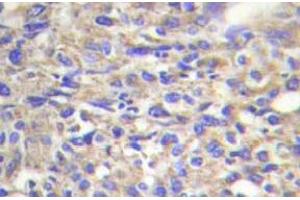 Immunohistochemistry (IHC) analyzes of Laminin beta-1 antibody in paraffin-embedded human liver carcinoma tissue. (Laminin beta 1 antibody)
