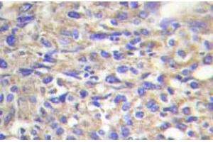 Immunohistochemistry (IHC) analyzes of Laminin beta-1 antibody in paraffin-embedded human liver carcinoma tissue. (Laminin beta 1 antibody)
