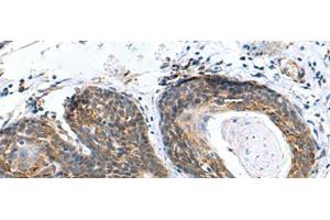 Immunohistochemistry of paraffin-embedded Human esophagus cancer tissue using AP1S3 Polyclonal Antibody at dilution of 1:70(x200) (AP1S3 antibody)