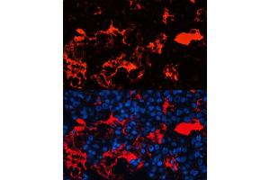 Immunofluorescence analysis of human liver cancer cells using Albumin antibody (ABIN3021924, ABIN3021925, ABIN3021926, ABIN1512560 and ABIN6217701) at dilution of 1:100.