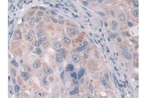 DAB staining on IHC-P; Samples: Human Breast cancer Tissue (FcRn antibody  (AA 24-365))