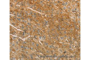 Immunohistochemistry of Human thyroid cancer using VTN Polyclonal Antibody at dilution of 1:40