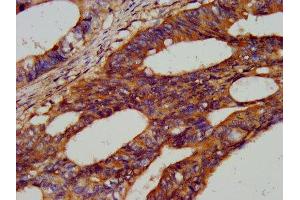IHC image of ABIN7145511 diluted at 1:300 and staining in paraffin-embedded human colon cancer performed on a Leica BondTM system. (HEXB antibody  (AA 408-528))