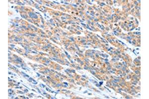 The image on the left is immunohistochemistry of paraffin-embedded Human esophagus cancer tissue using ABIN7128229(ADAM2 Antibody) at dilution 1/20, on the right is treated with fusion protein.