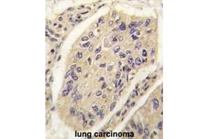 Formalin-fixed and paraffin-embedded human lung carcinoma tissue reacted with GHRH antibody (N-term) (ABIN392174 and ABIN2841887) , which was peroxidase-conjugated to the secondary antibody, followed by DAB staining. (GHRH antibody  (N-Term))