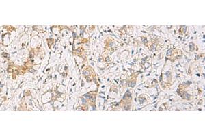 Immunohistochemistry of paraffin-embedded Human liver cancer tissue using FYCO1 Polyclonal Antibody at dilution of 1:110(x200) (FYCO1 antibody)