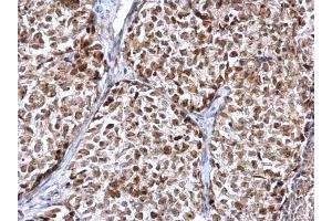 IHC-P Image FEN1 antibody detects FEN1 protein at nucleus on human breast carcinoma by immunohistochemical analysis.