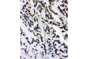 Anti-SNRPN antibody, IHC(P) IHC(P): Human Intestinal Cancer Tissue (SNRPN antibody  (N-Term))
