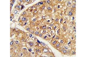 IHC analysis of FFPE human hepatocarcinoma stained with GARP antibody (LRRC32 antibody  (AA 234-260))
