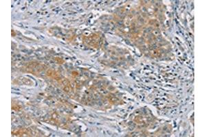 The image on the left is immunohistochemistry of paraffin-embedded Human ovarian cancer tissue using ABIN7192147(RASA2 Antibody) at dilution 1/45, on the right is treated with synthetic peptide. (RASA2 antibody)