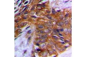 Immunohistochemical analysis of PAK1 (pT212) staining in human prostate cancer formalin fixed paraffin embedded tissue section. (PAK1 antibody  (pSer212))
