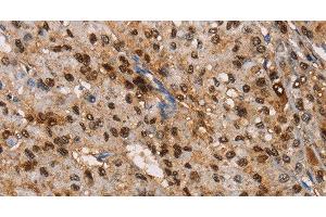 Immunohistochemistry of paraffin-embedded Human liver cancer tissue using TSPEAR Polyclonal Antibody at dilution 1:50 (TSPEAR antibody)