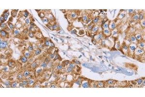 Immunohistochemistry of paraffin-embedded Human breast cancer tissue using GUCY1A3 Polyclonal Antibody at dilution 1:40 (GUCY1A1 antibody)