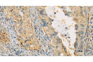 Immunohistochemistry of paraffin-embedded Human cervical cancer tissue using APOA4 Polyclonal Antibody at dilution 1:30 (APOA4 antibody)