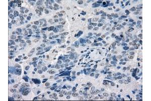 Immunohistochemical staining of paraffin-embedded Adenocarcinoma of breast tissue using anti-POR mouse monoclonal antibody. (POR antibody)